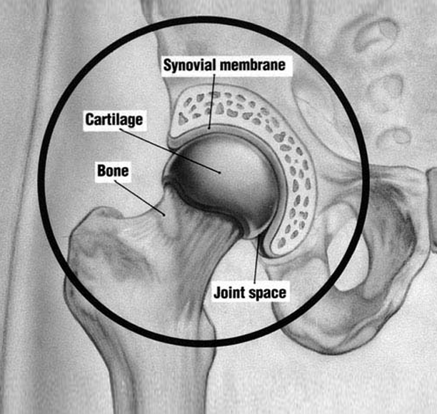 main cause of arthritis