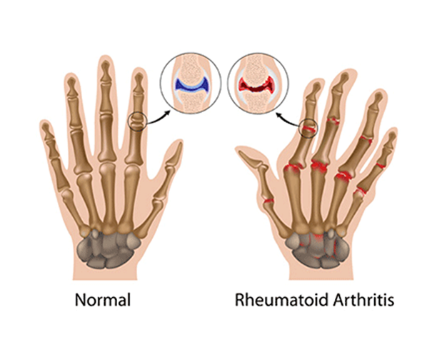 rheumatoid arthritis