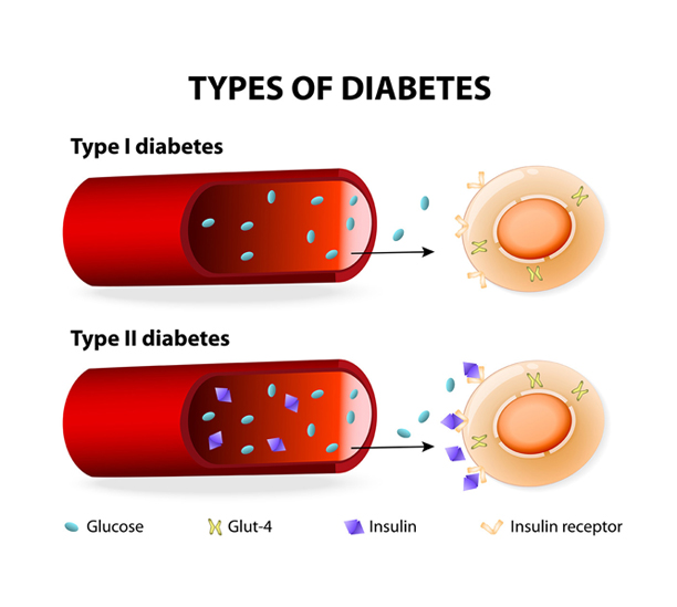 type-of-diabetes